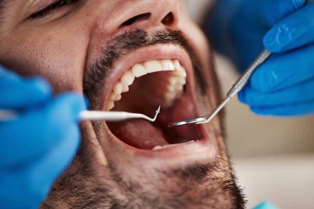 Best Emergency Wisdom Teeth Removal in Caddo, OK